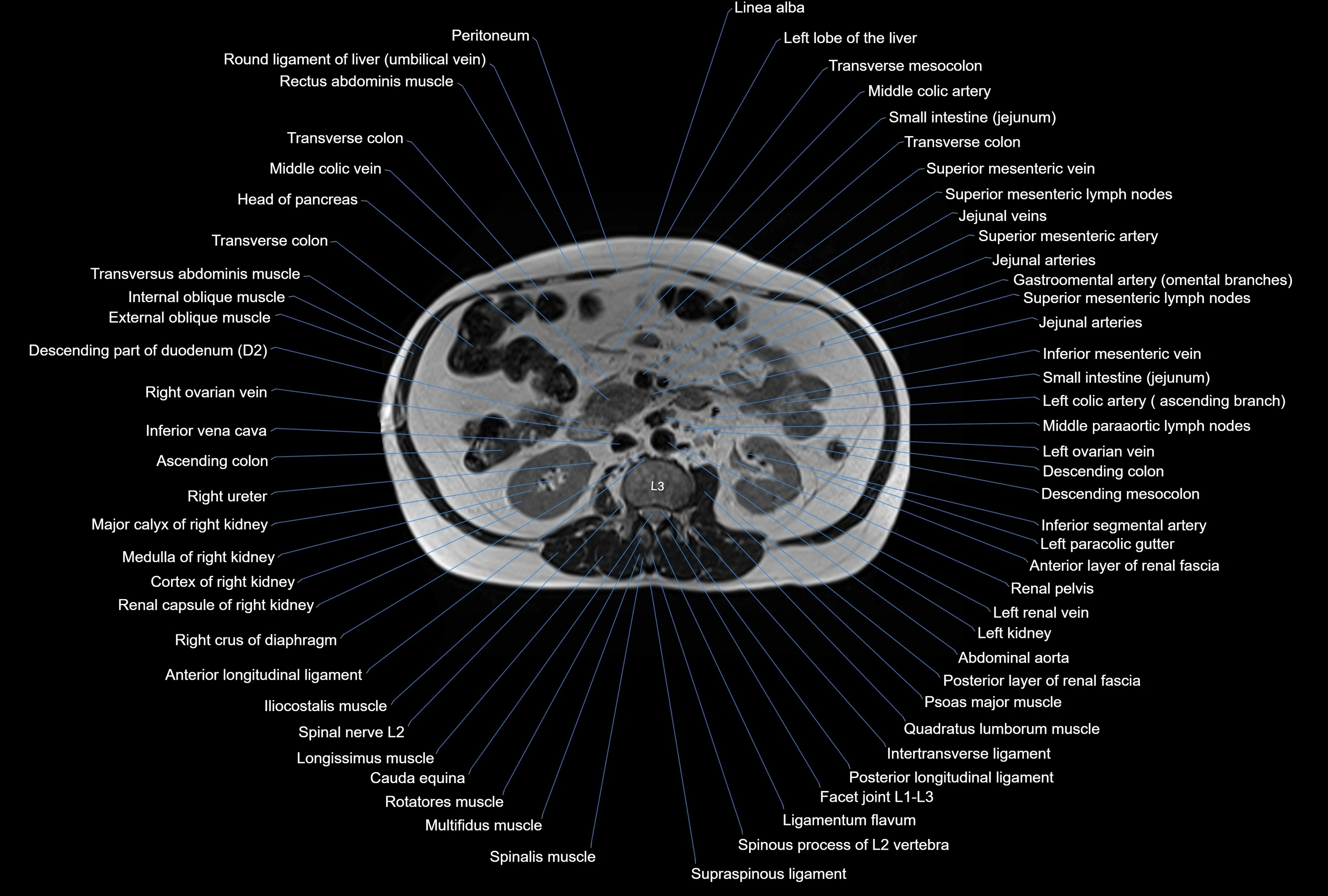 MRI Abdomen axial cross sectional anatomy radiology  image-img-00001-00024.webp